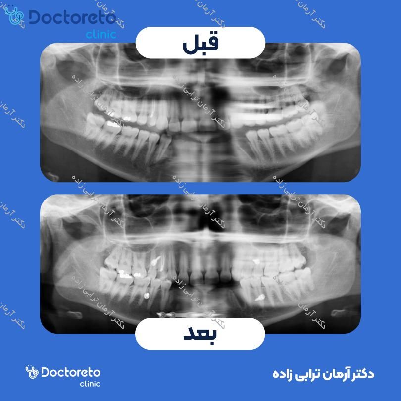 ایمپلنت اشترومن ساده تیتانیومی سوئیسی با روکش (هر واحد) دکتر آرمان ترابی زاده در تهران 6