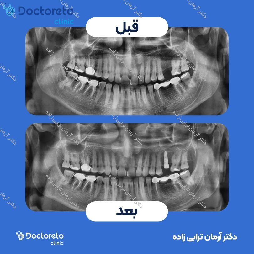 ایمپلنت کره ای dio با روکش (هر واحد) دکتر آرمان ترابی زاده در تهران 7