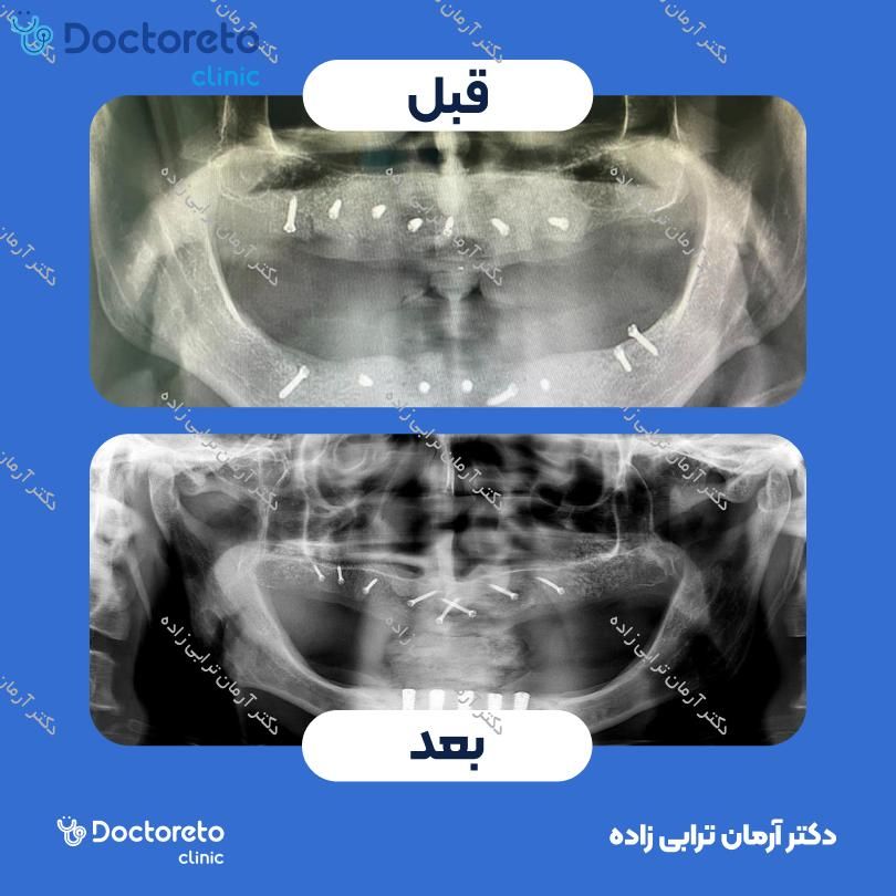 ایمپلنت کره ای dio با روکش (هر واحد) دکتر آرمان ترابی زاده در تهران 12