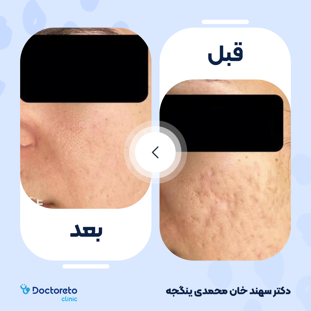 جوانسازی صورت با مزوتراپی برند هیدرالیفت (هر جلسه)