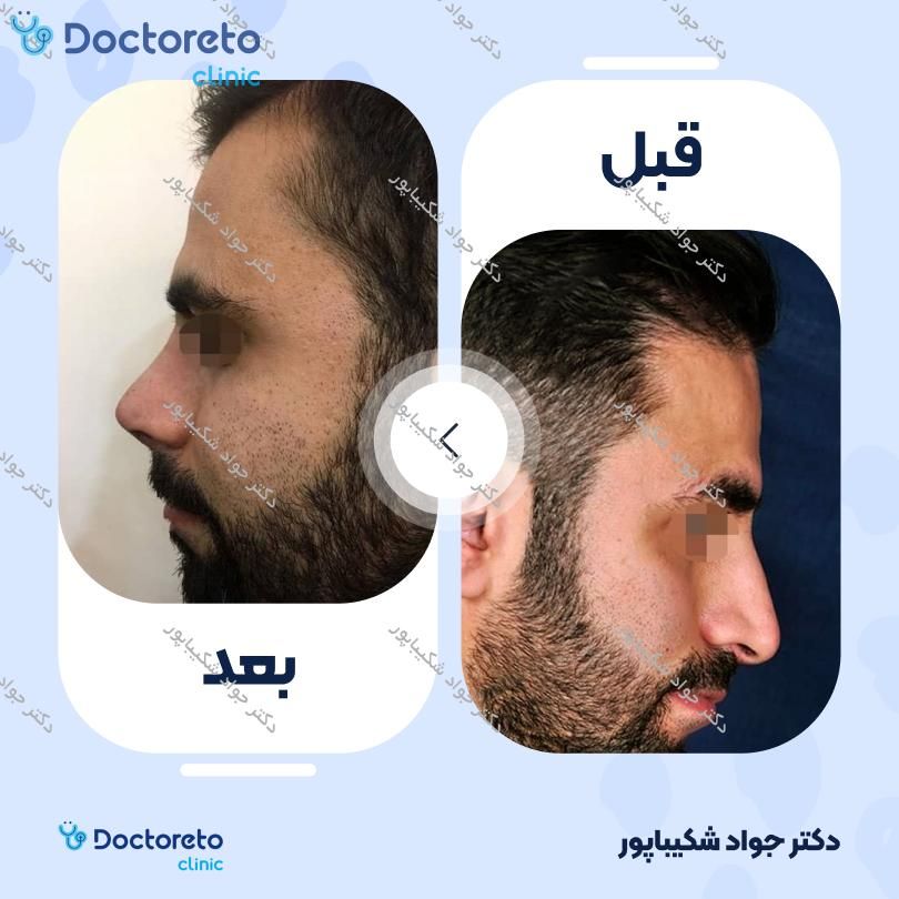 عمل زیبایی بینی (رینوپلاستی) دکتر جواد شکیباپور در شیراز 11