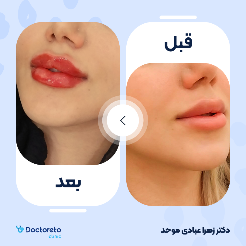 تزریق ژل لب با برند اینووسنس (1CC)