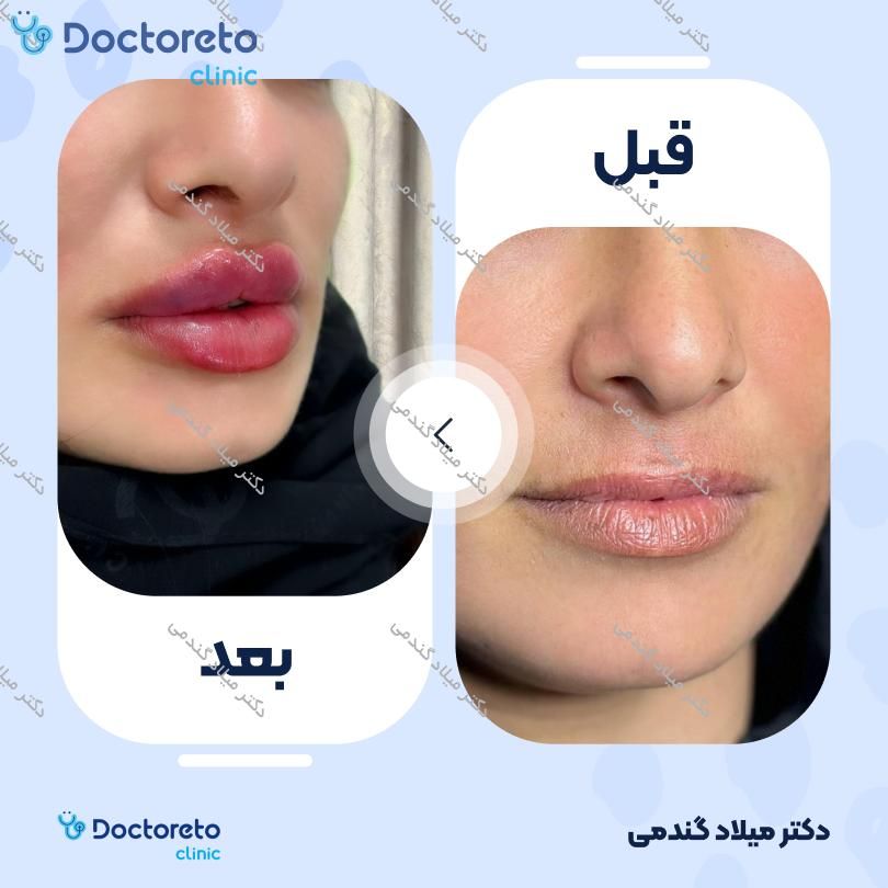 تزریق ژل لب با برند آلیاکسین (1CC)