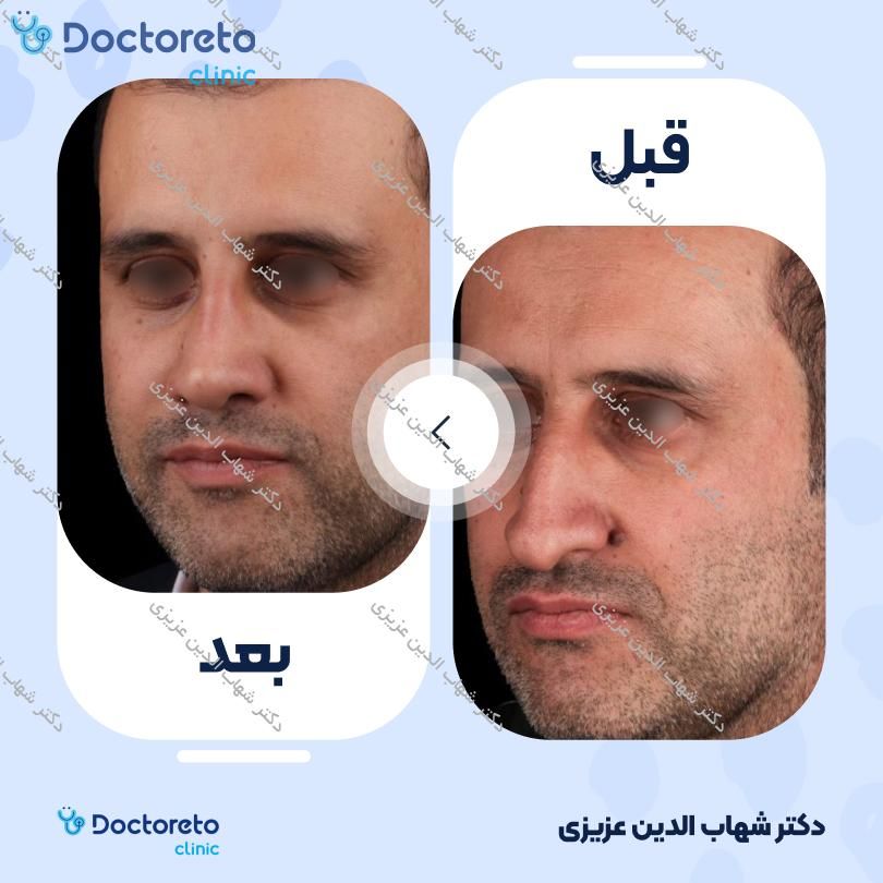 عمل زیبایی بینی (رینوپلاستی) دکتر شهاب الدین عزیزی در تهران 10