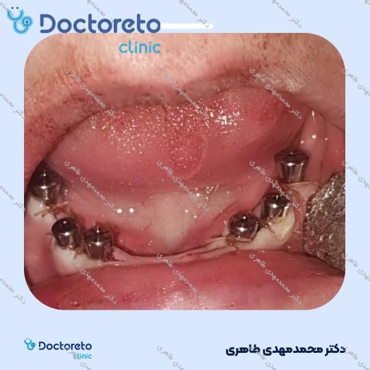 ایمپلنت کره ای مگاژن با روکش (هر واحد)