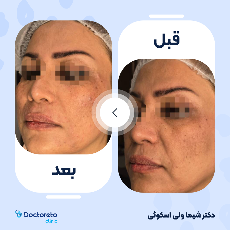 تزریق ژل خط خنده با برند اینووسنس (1cc)