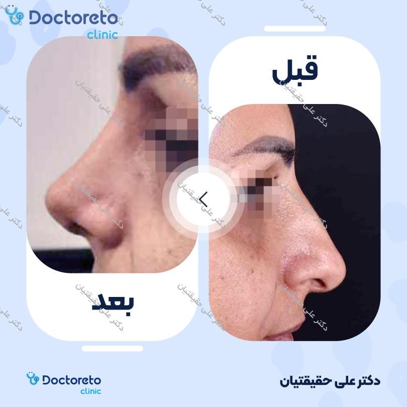 جراحی انحراف بینی (سپتوپلاستی) دکتر علی حقیقتیان در شیراز 2