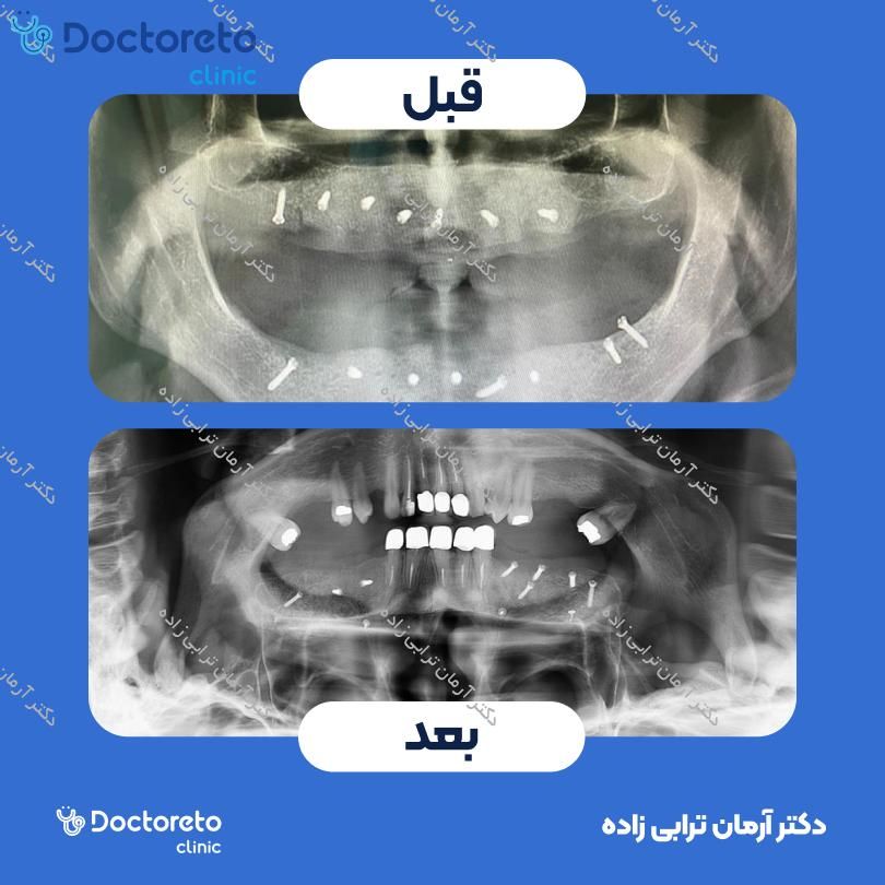 جراحی پیوند استخوان پیشرفته با تگ (هرواحد) دکتر آرمان ترابی زاده در تهران 4