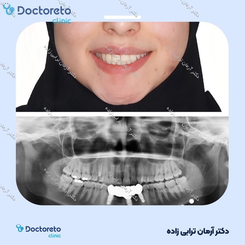 ایمپلنت اشترومن ساده تیتانیومی سوئیسی با روکش (هر واحد) دکتر آرمان ترابی زاده در تهران 8