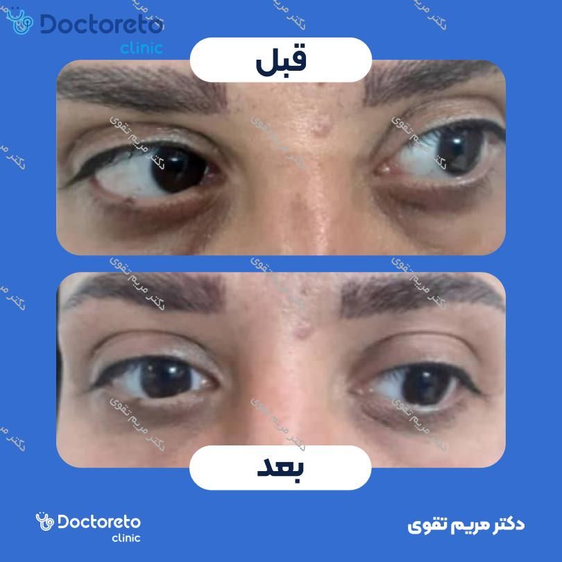 تزریق بوتاکس صورت (پیشانی، خط اخم، دورچشم) با برند دیستون دکتر مریم تقوی در مشهد 2