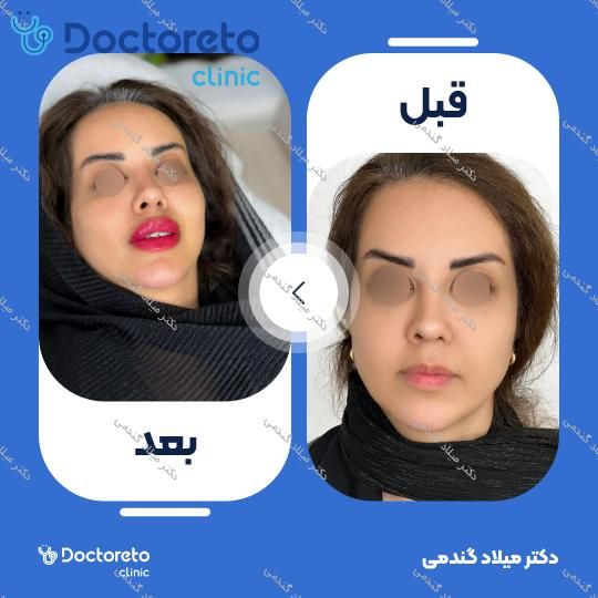 تزریق ژل لب با برند نئوویا (1CC)