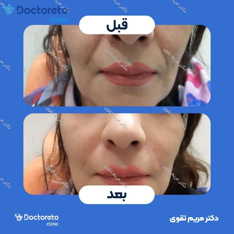 تزریق ژل خط خنده با برند درم آرکین (1CC) دکتر مریم تقوی در مشهد 2