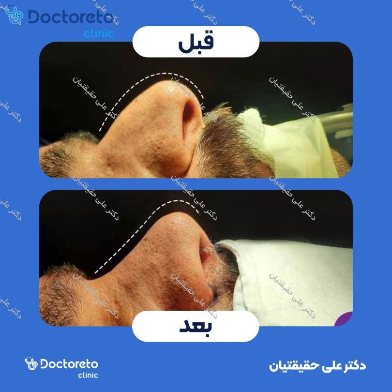 عمل زیبایی بینی (رینوپلاستی) دکتر علی حقیقتیان در شیراز 10