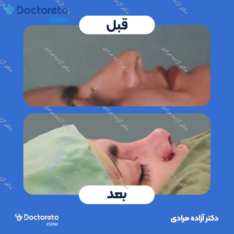 عمل جراحی مجدد زیبایی بینی (رینوپلاستی) دکتر آزاده مرادی در شیراز 8