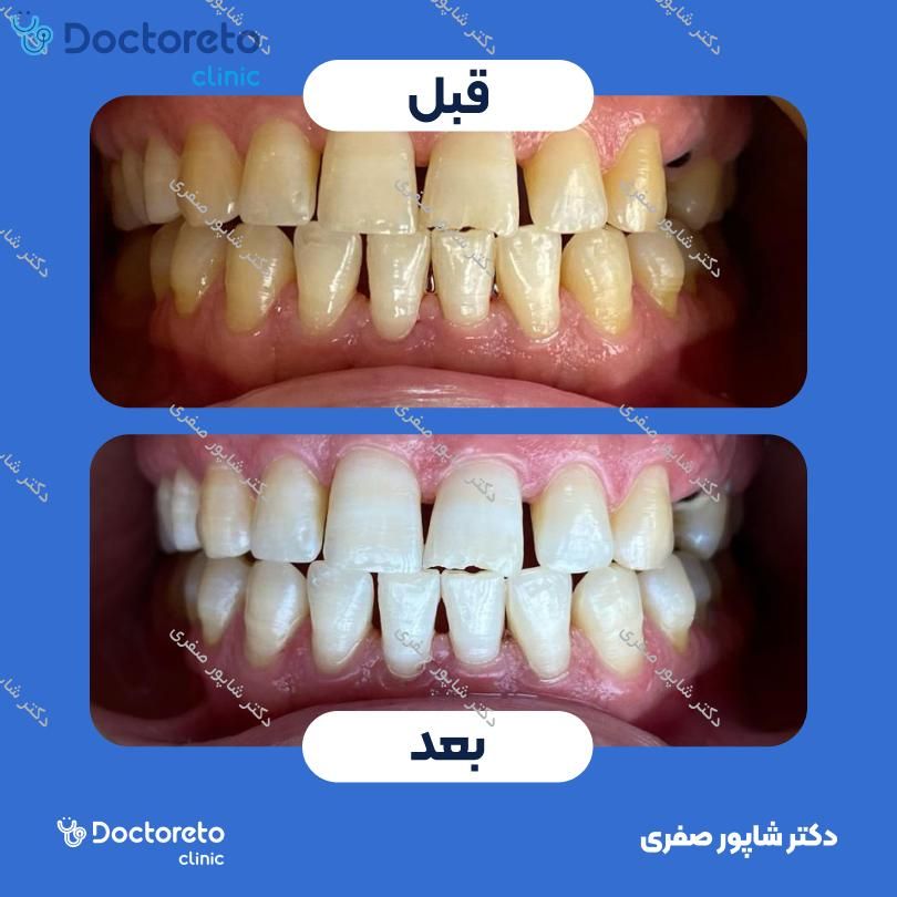 آفیس بلیچینگ (سفید کردن دندان) دو فک با مواد آلمانی دکتر شاپور صفری در تهران 3