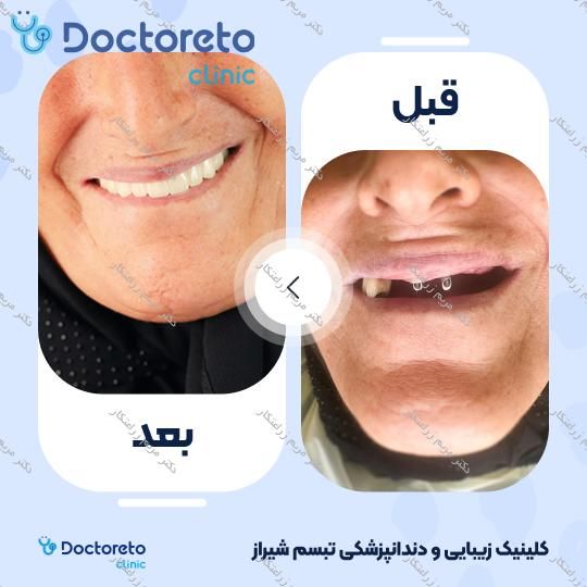 روکش ایمپلنت دیجیتال کره ای dio (هر واحد) دکتر مریم زراعتکار در شیراز 5