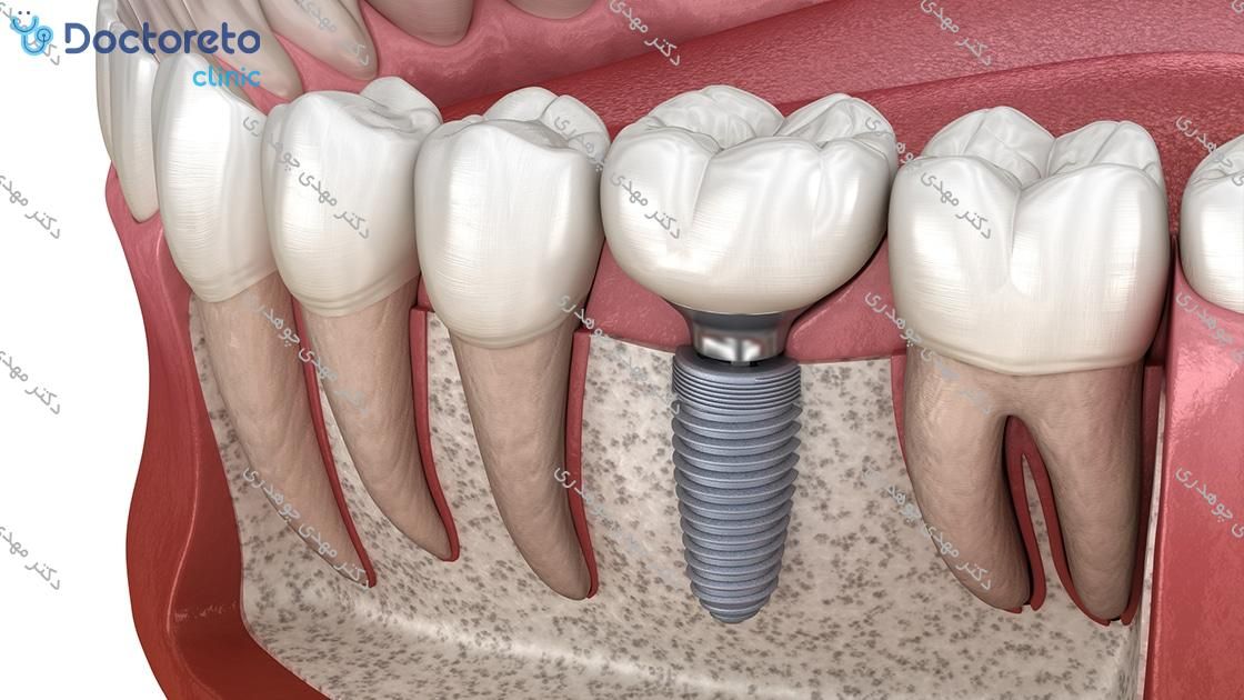 ایمپلنت دیجیتال دنتیوم کره بدون روکش (هر واحد)