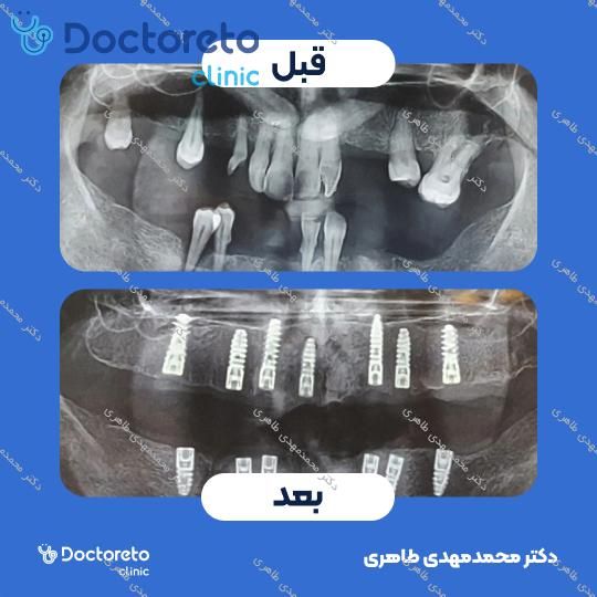 ایمپلنت نئودنت (neodent) سوئیسی همراه با روکش (هر واحد)