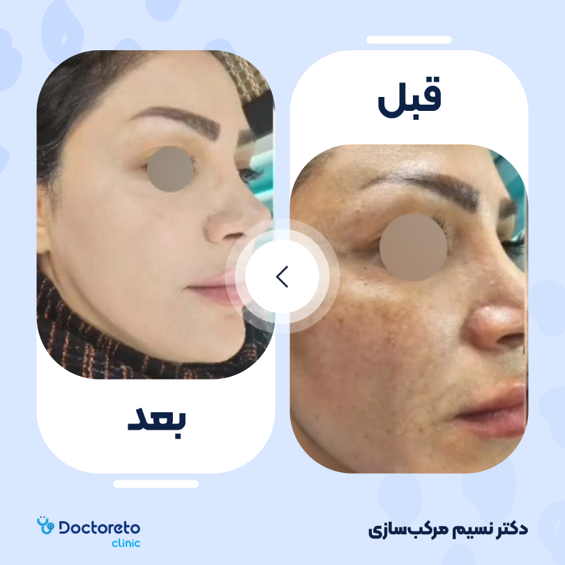 جوانسازی صورت با لیزر rf فرکشنال (یک جلسه)