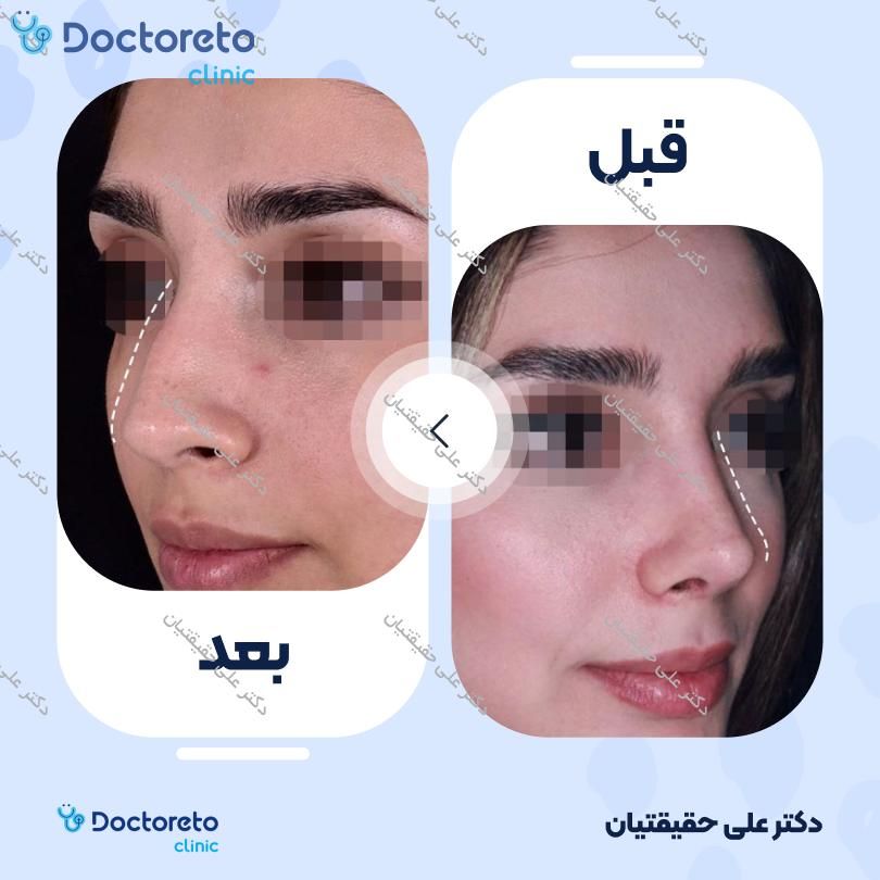 عمل جراحی مجدد زیبایی بینی (رینوپلاستی) دکتر علی حقیقتیان در شیراز 3