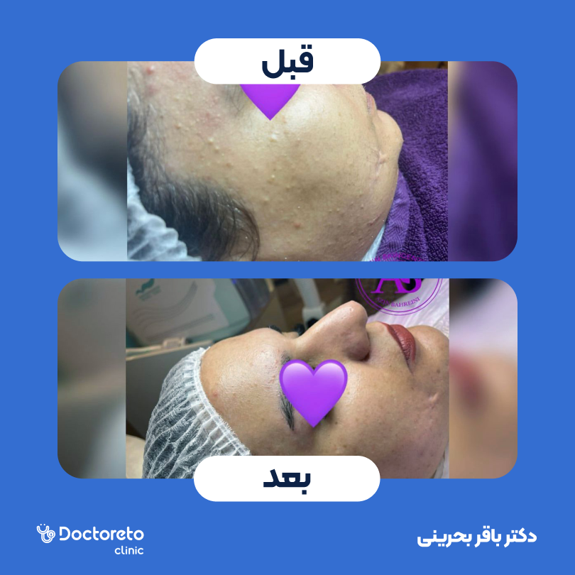 فیشیال کلاسیک (پاکسازی) صورت دکتر باقر بحرینی در کرمان 3