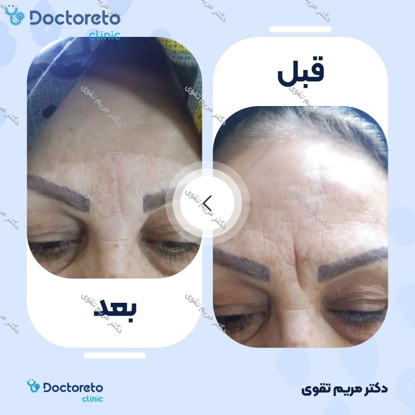 تزریق بوتاکس صورت (پیشانی، خط اخم، دورچشم) با برند دیستون