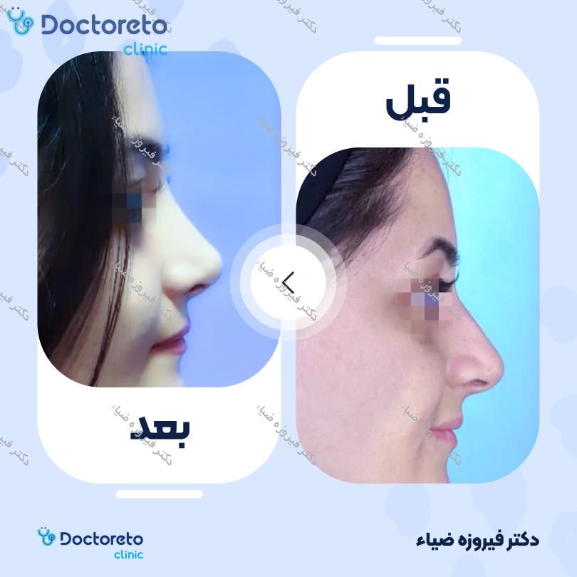 عمل زیبایی بینی (رینوپلاستی) دکتر فیروزه ضیاء در رشت 10