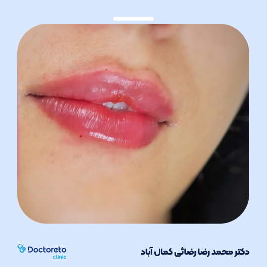 تزریق ژل لب با برند رووفیل (1cc) دکتر محمدرضا رضائی کمال آباد در کرمان 3