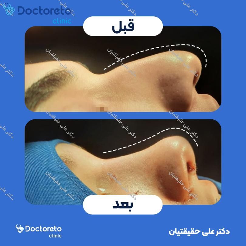 عمل جراحی مجدد زیبایی بینی (رینوپلاستی) دکتر علی حقیقتیان در شیراز 7