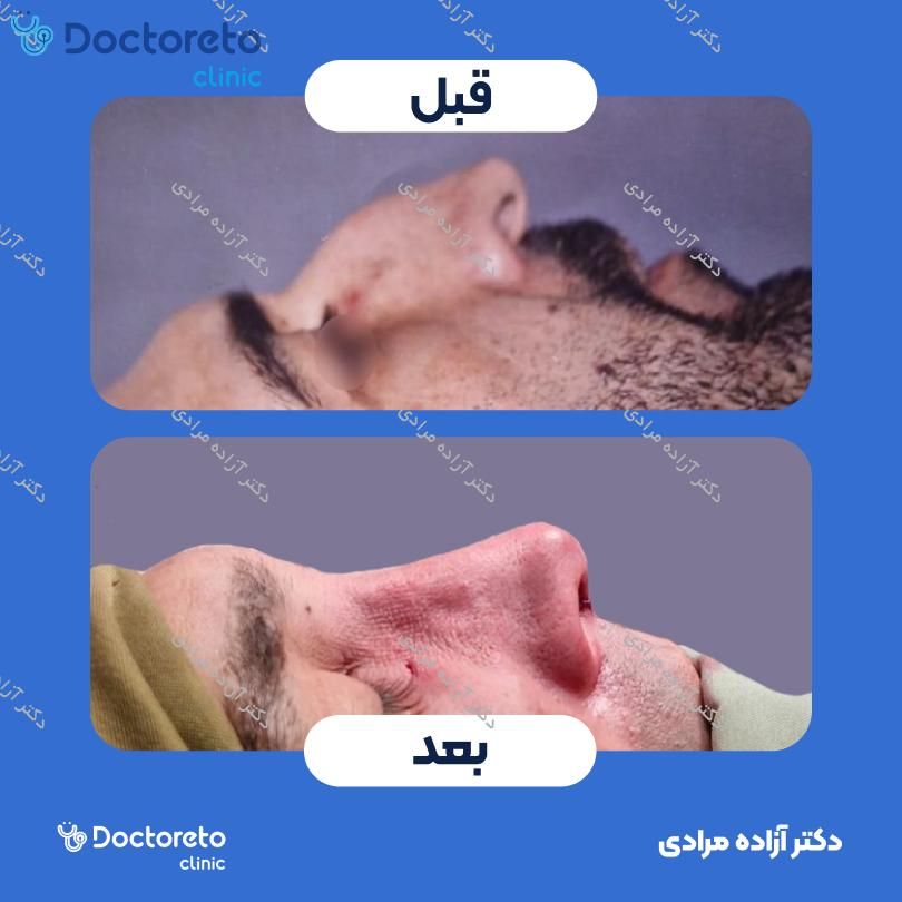 عمل جراحی بینی (رینوپلاستی) دکتر آزاده مرادی در شیراز 10