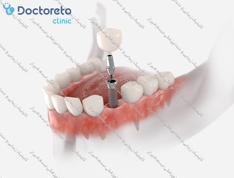 ایمپلنت دیجیتال dio کره ای با روکش (هر واحد) کلینیک زیبایی و دندانپزشکی تبسم شیراز در شیراز 2