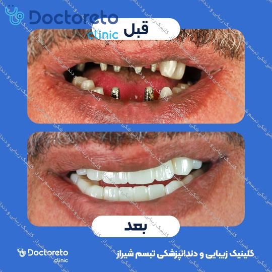 ایمپلنت دیجیتال دنتیس کره ای با روکش (هر واحد) کلینیک زیبایی و دندانپزشکی تبسم شیراز در شیراز 14