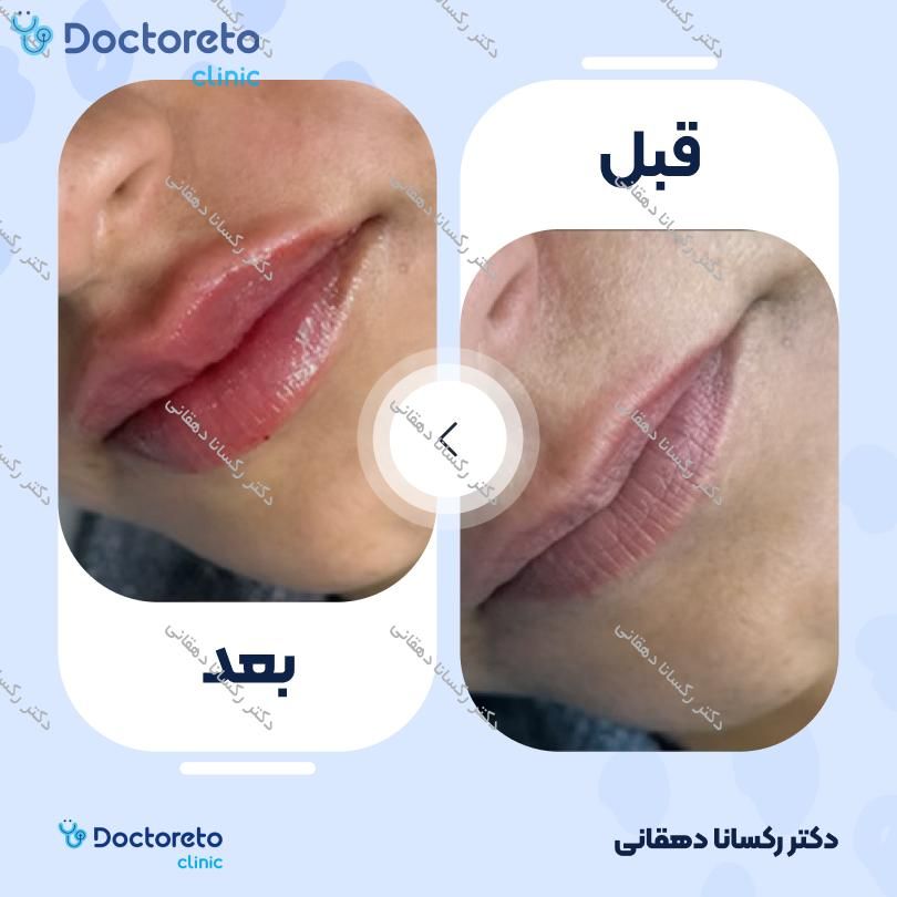 تزریق ژل لب با برند درمال استایل (1cc) دکتر رکسانا دهقانی در شیراز 3