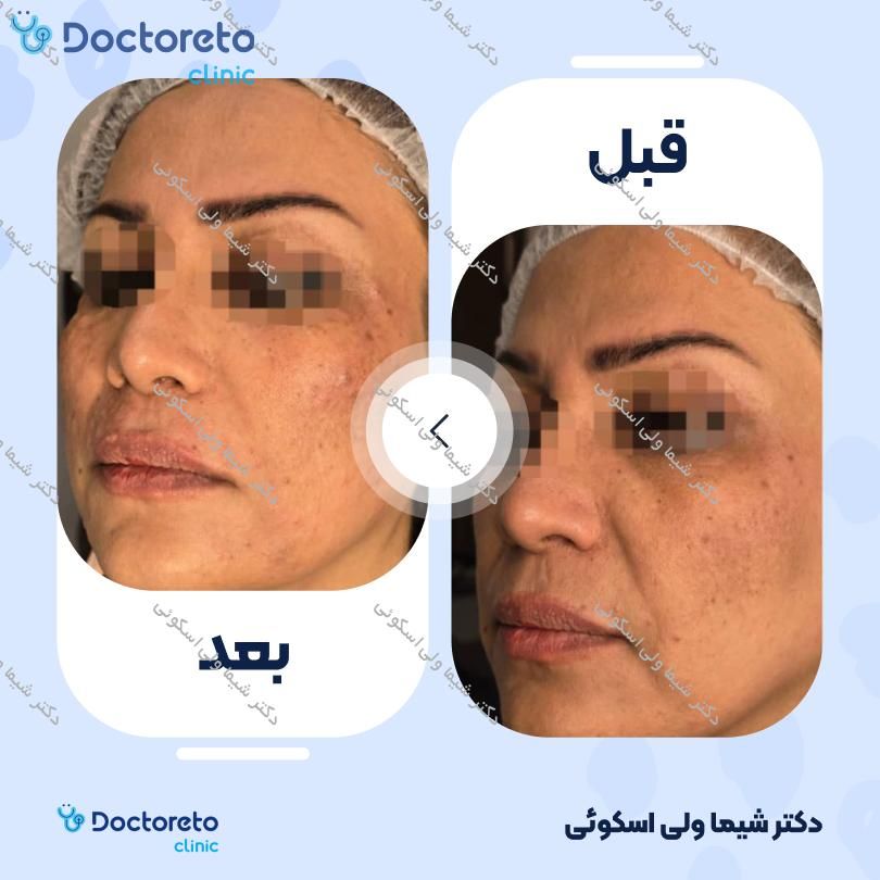 تزریق ژل گونه با برند اینووسنس (1cc)