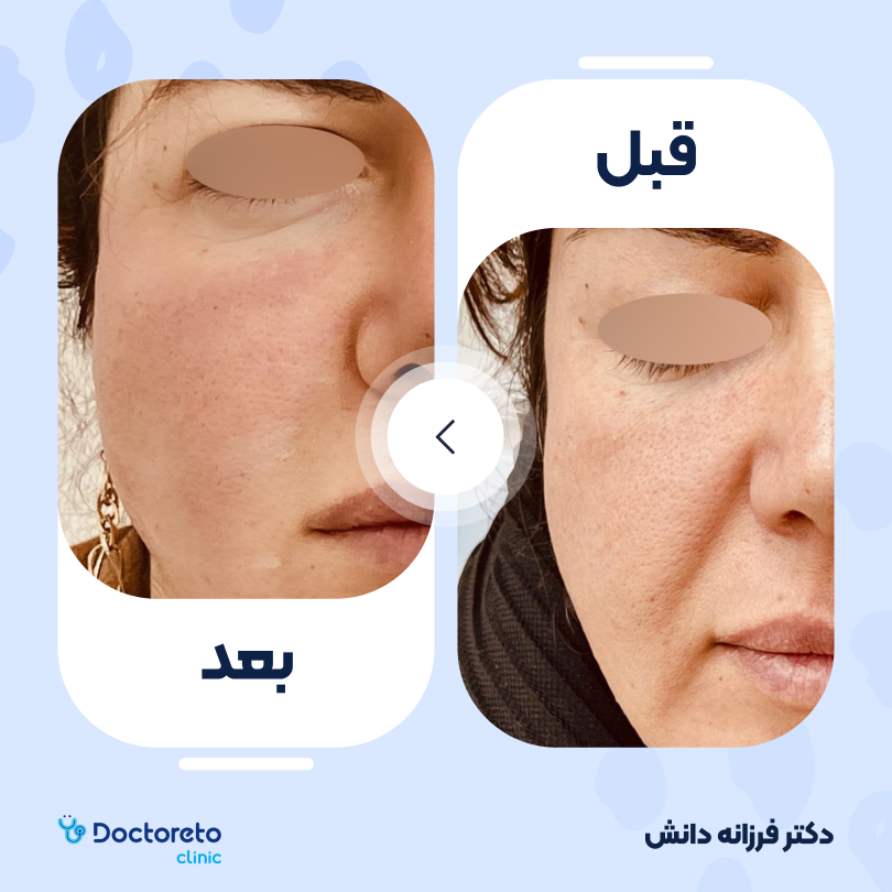 تزریق ژل خط خنده با برند ریوانس (1cc)