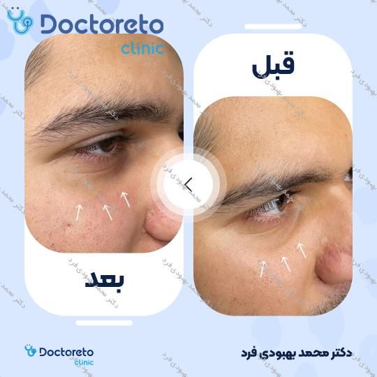 تزریق ژل زیر چشم با برند رووفیل فاین (1CC) دکتر محمد بهبودی فرد در مشهد 4