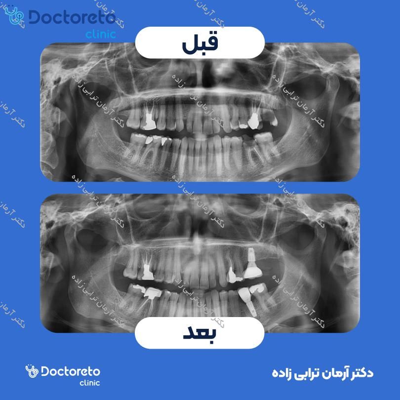 ایمپلنت icx آلمانی بدون روکش (هر واحد) دکتر آرمان ترابی زاده در تهران 3