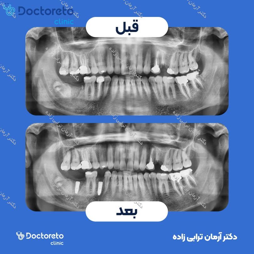 ایمپلنت اشترومن Roxolid active سوئیسی با روکش (هر واحد) دکتر آرمان ترابی زاده در تهران 15