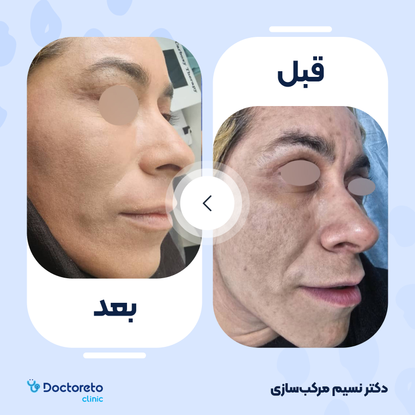 جوانسازی صورت با لیزر rf فرکشنال (یک جلسه) دکتر نسیم مرکب سازی در تهران 2