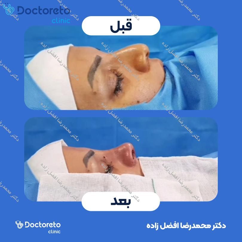 عمل زیبایی بینی (رینوپلاستی) دکتر محمدرضا افضل زاده در مشهد 3