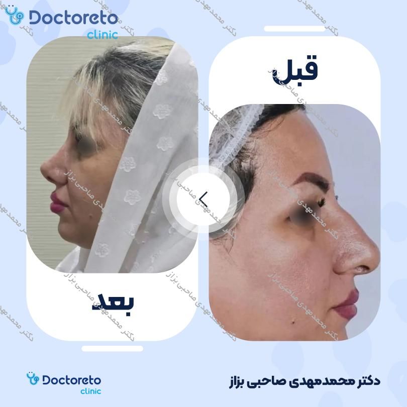 عمل زیبایی بینی (رینوپلاستی) دکتر محمدمهدی صاحبی بزاز در اهواز 7