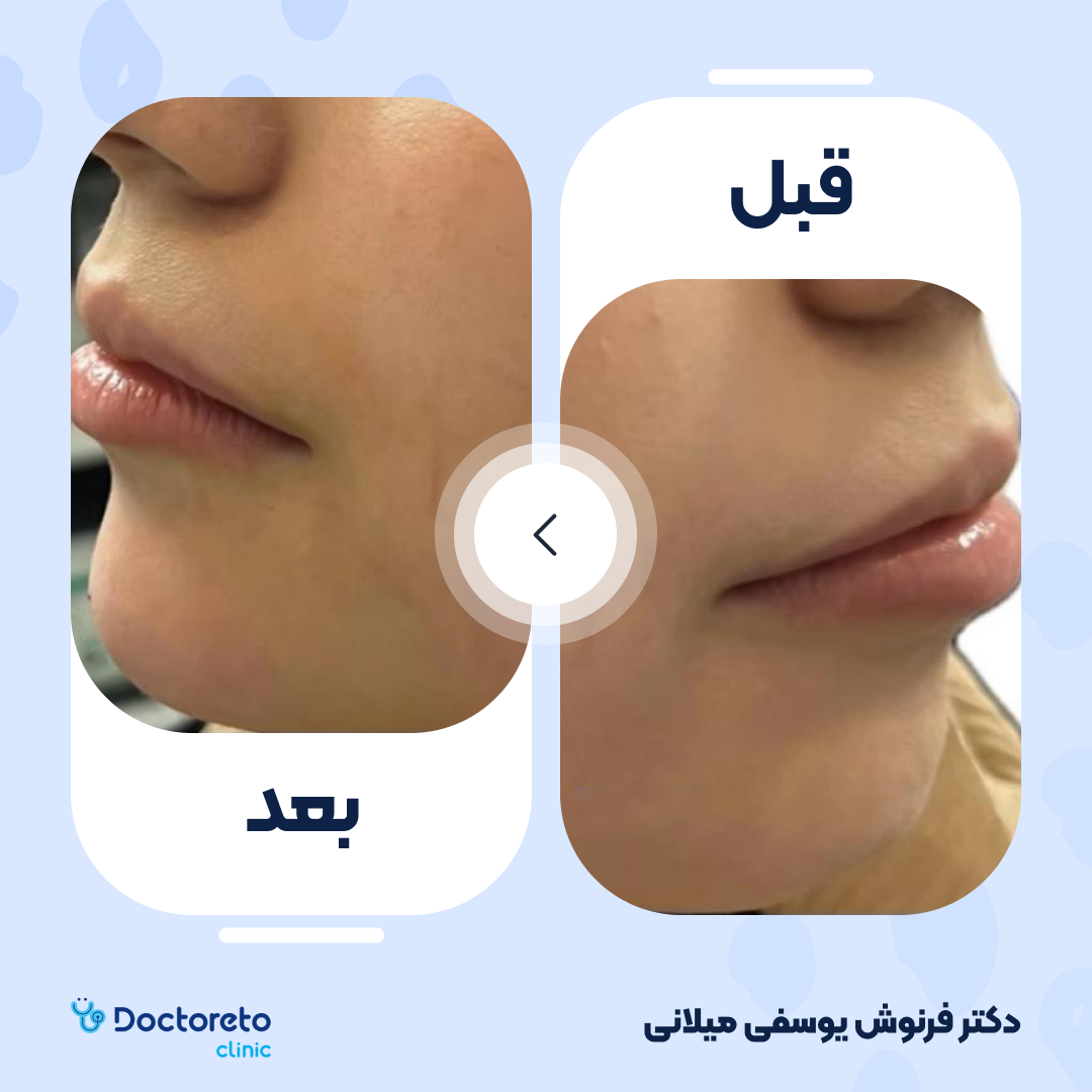 تزریق ژل چانه با برند پرفکتا (1cc) دکتر فرنوش یوسفی میلانی در تهران 2