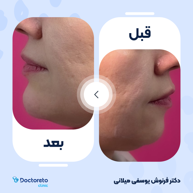 تزریق ژل چانه با برند پرفکتا (1cc)