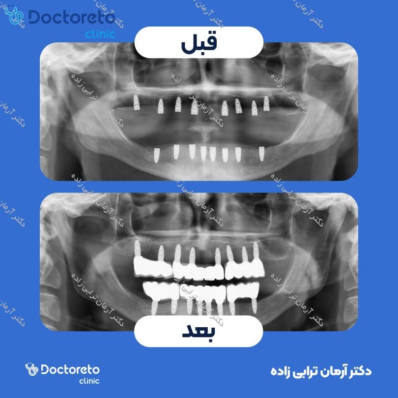 ایمپلنت اشترومن Roxolid active سوئیسی با روکش (هر واحد) دکتر آرمان ترابی زاده در تهران 2