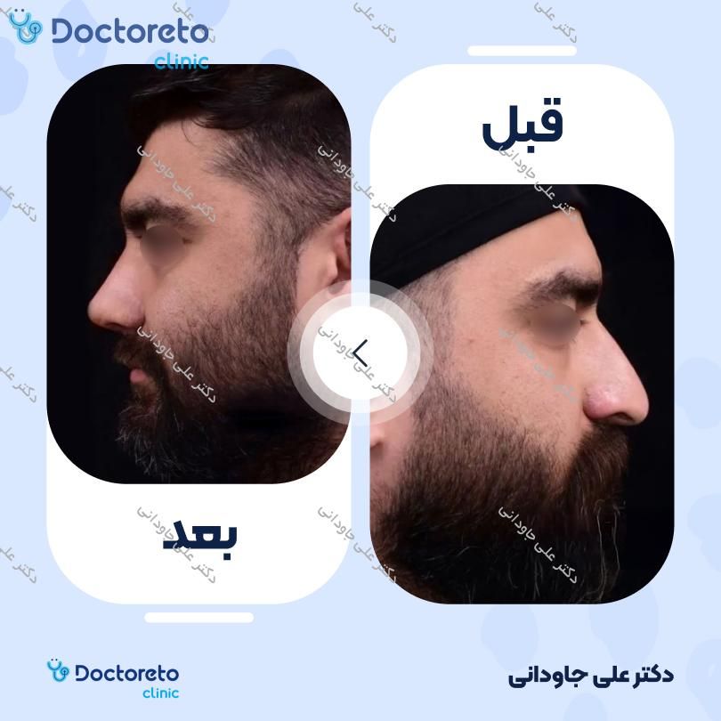 عمل زیبایی بینی (رینوپلاستی) دکتر علی جاودانی در تهران 4