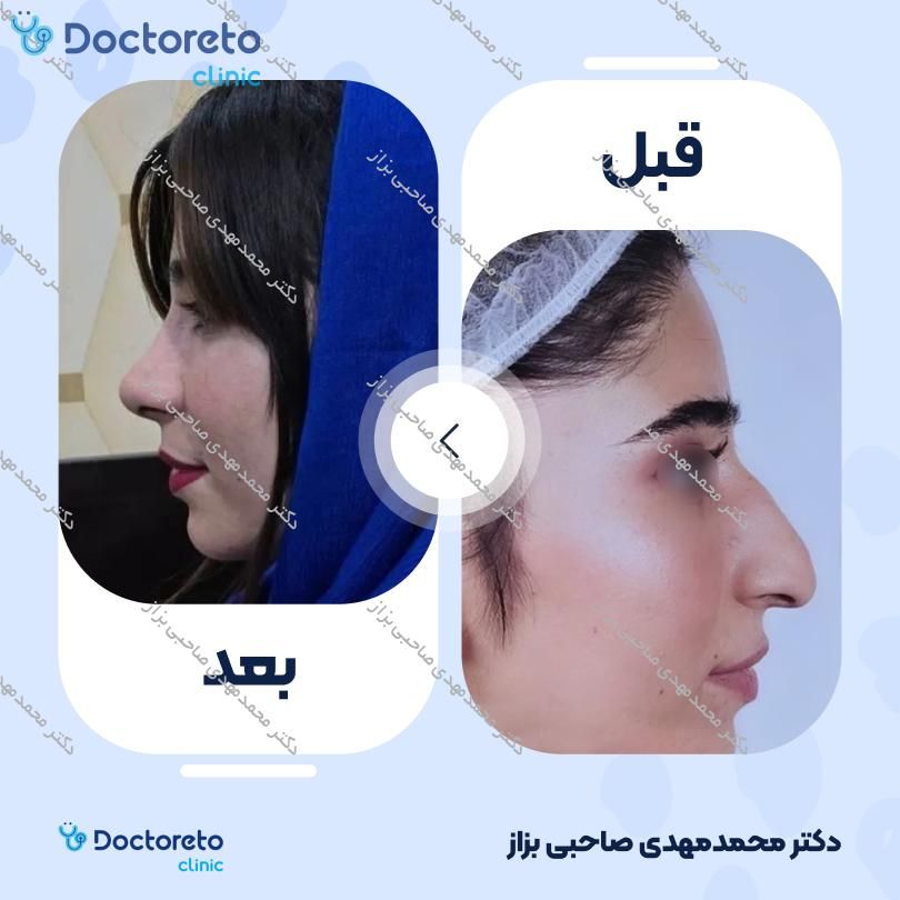 جراحی انحراف بینی (سپتوپلاستی) دکتر محمدمهدی صاحبی بزاز در اهواز 6