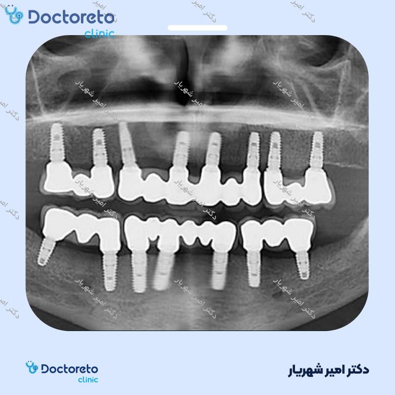 ایمپلنت دنتیوم کره ای بدون روکش (هر واحد) دکتر امیر شهریار در تهران 3