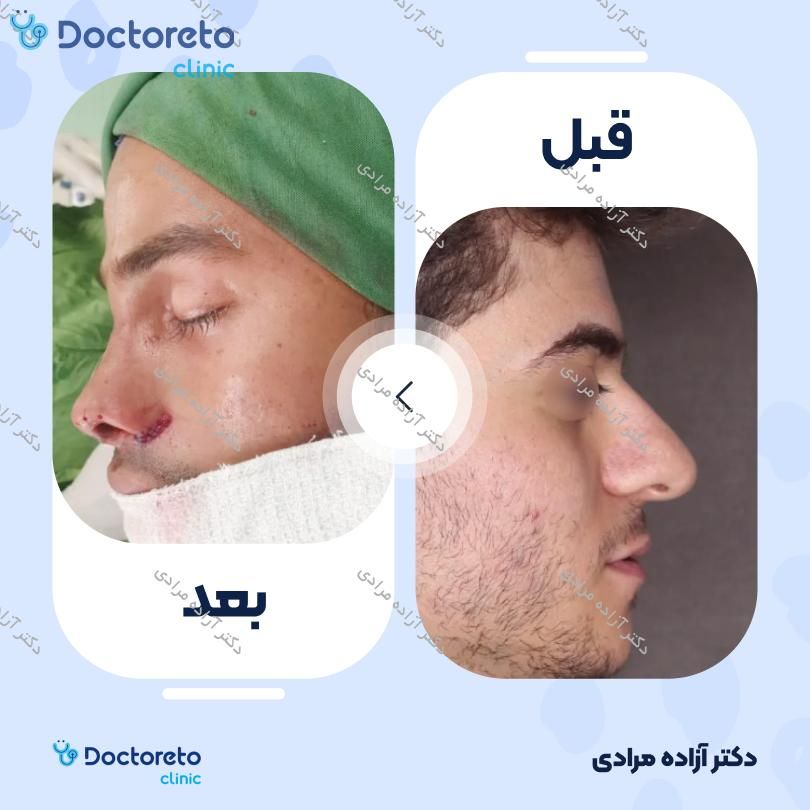 عمل جراحی بینی (رینوپلاستی) دکتر آزاده مرادی در شیراز 5