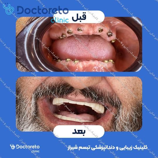 ایمپلنت دیجیتال dio کره ای با روکش (هر واحد)