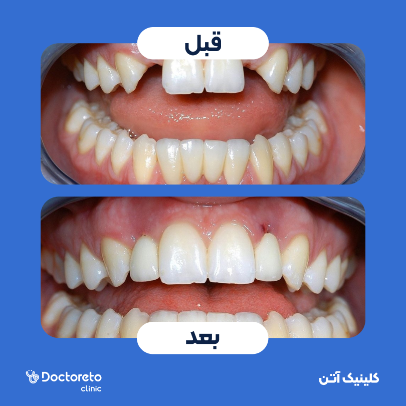 ایمپلنت کره ای همراه با روکش کلینیک دندانپزشکی آتن در تهران 2